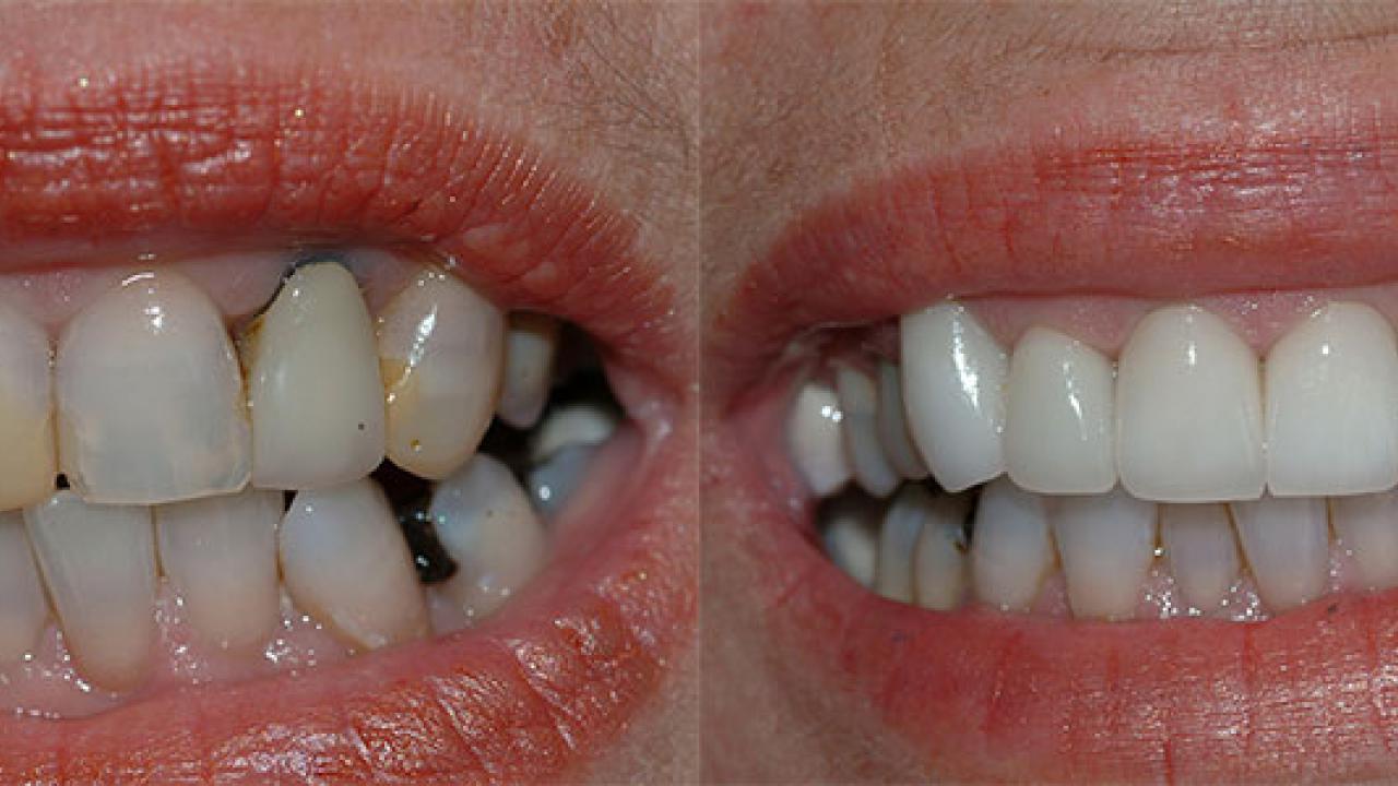 anterior crowns2