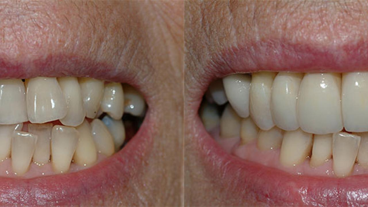 crowns veneers3