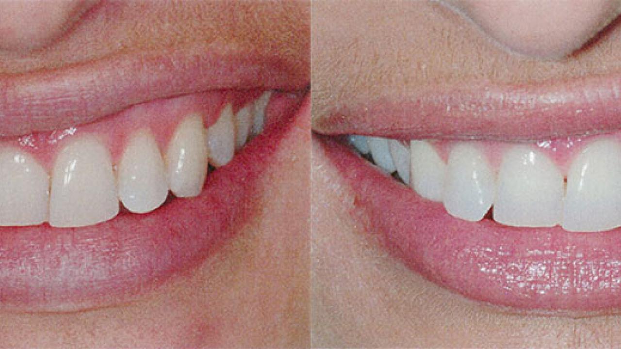 whitening