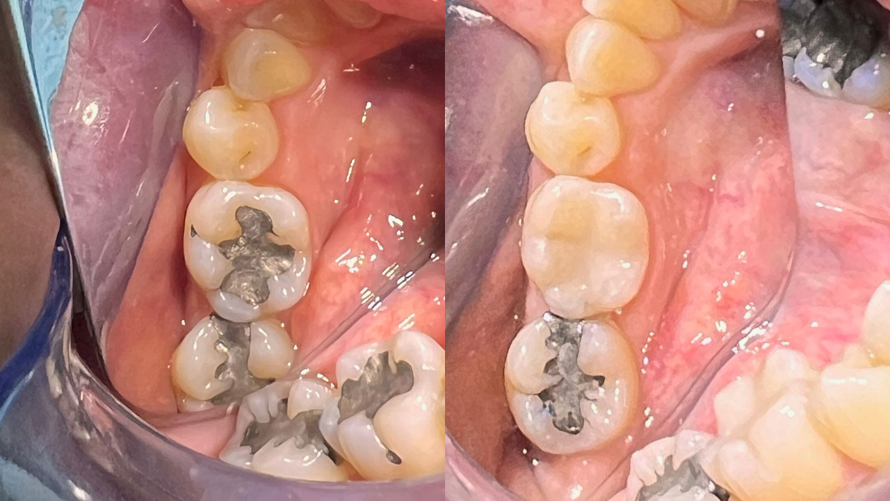 dhca composite case